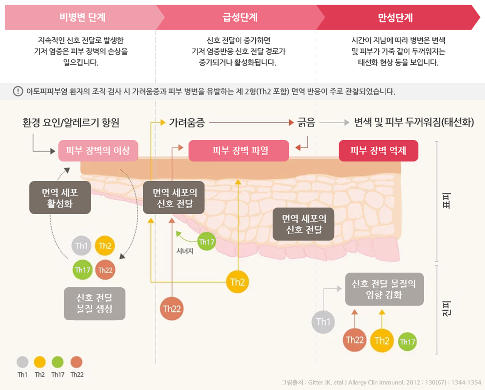 아토피피부염, 보이지 않는 곳에도 염증이 있습니다.