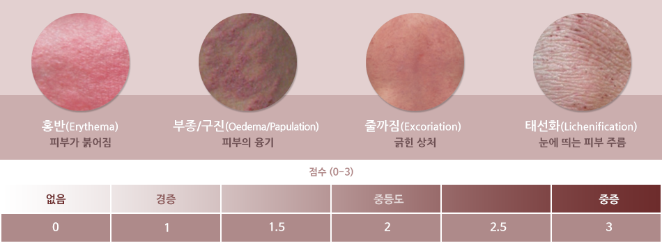 피부병변의 중증도 체크하기