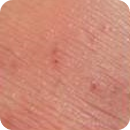 태선화 : 오랫동안 피부를 긁거나 문지르기 때문에 일어나는 눈에 띄는 피부 주름과 두꺼워짐