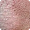 태선화 : 오랫동안 피부를 긁거나 문지르기 때문에 일어나는 눈에 띄는 피부 주름과 두꺼워짐